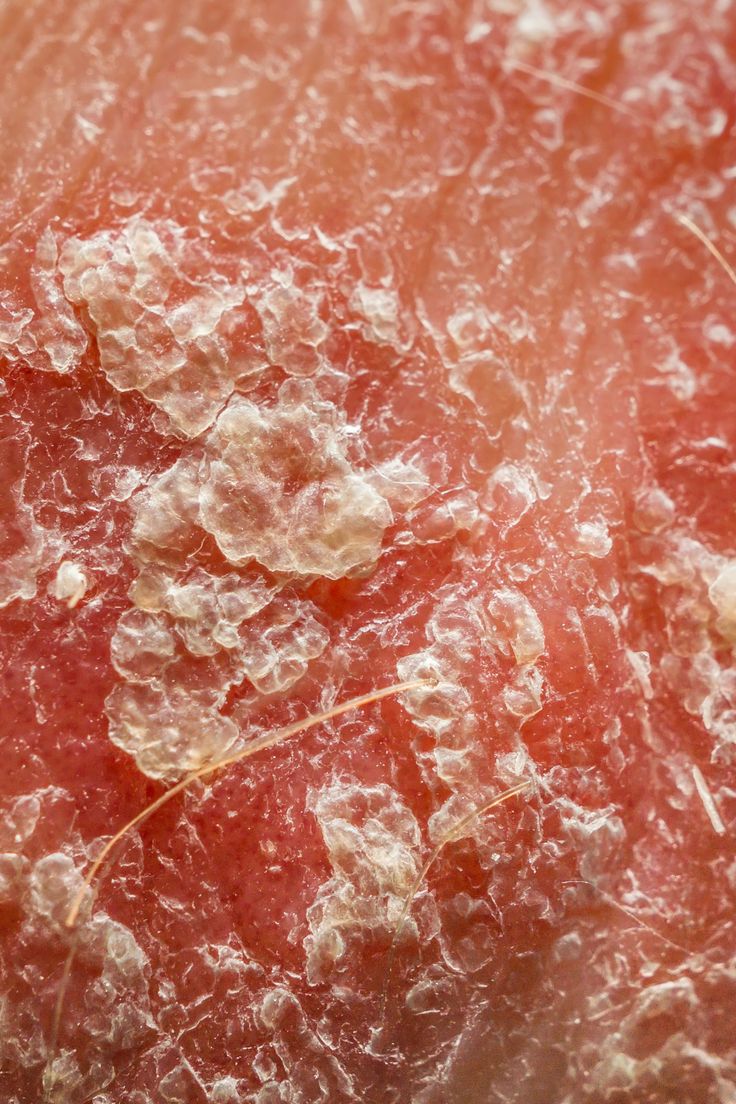 Psoriasis