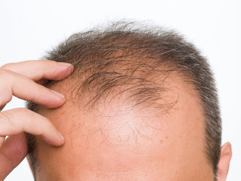 Perte de cheveux homme