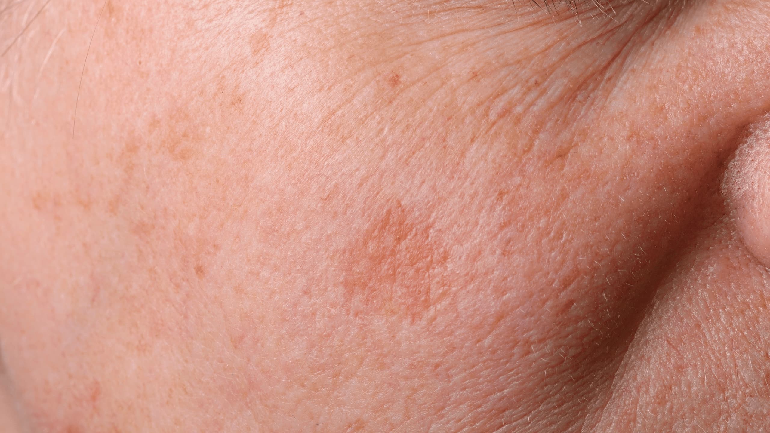 Hyperpigmentation